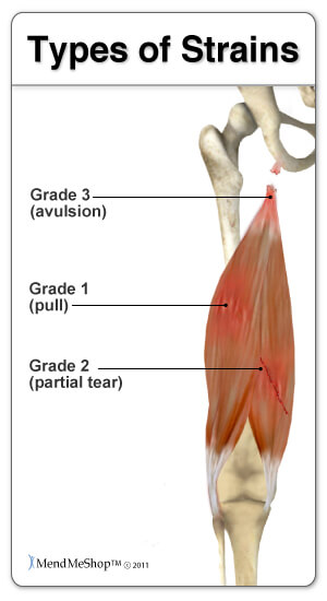 Hamstring Injuries in Soccer